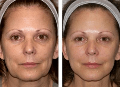 antes e despois