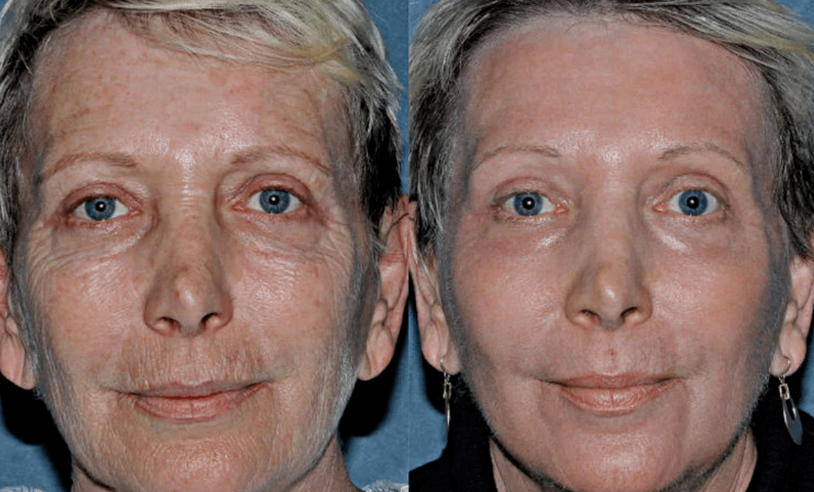 antes e despois